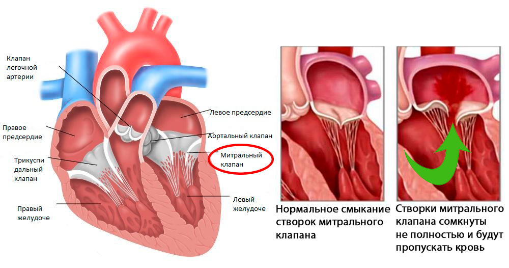 Порок клапанов сердца